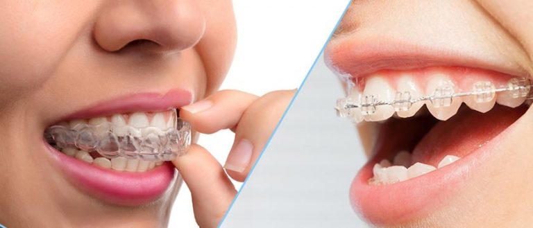 Types of Braces: Metal, Ceramic, Self-Ligating, Lingual and Clear Aligners