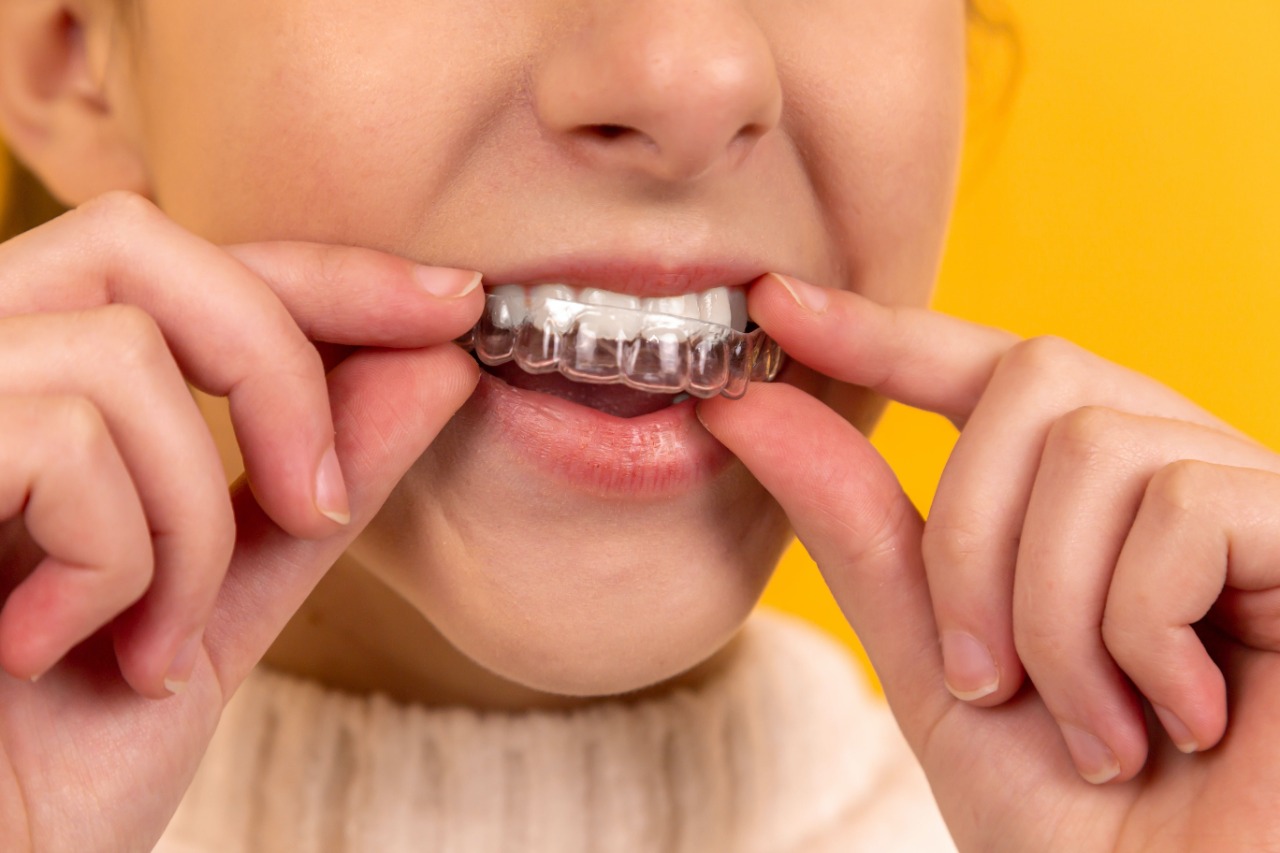 Benefits of Invisalign treatment at the best dental clinic in India