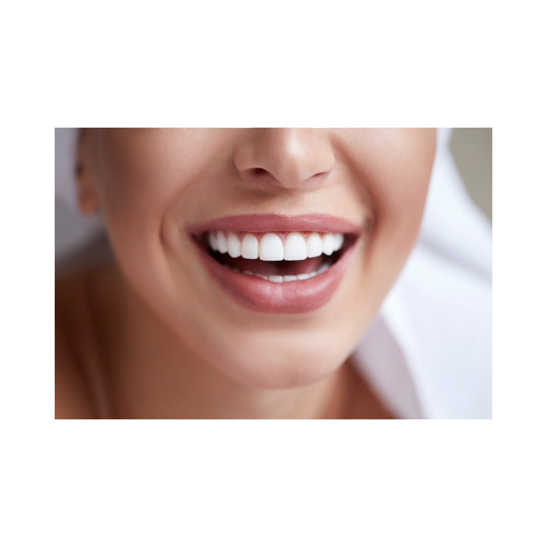 Zoom Teeth Whitening | Sterling Dental Clinic - Dental Blogs India