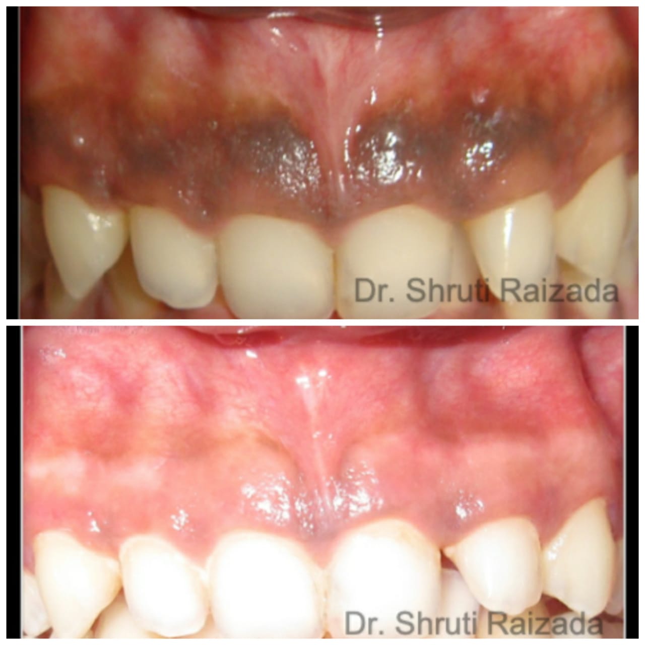 Gum Pigmentation | Sterling Dental Clinic - Dental Blogs India