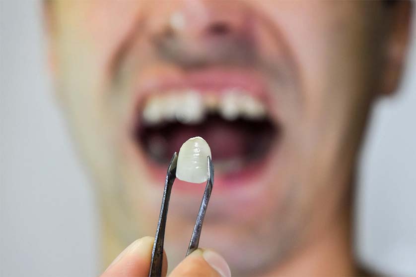 What to do if Your Tooth is Knocked Out
