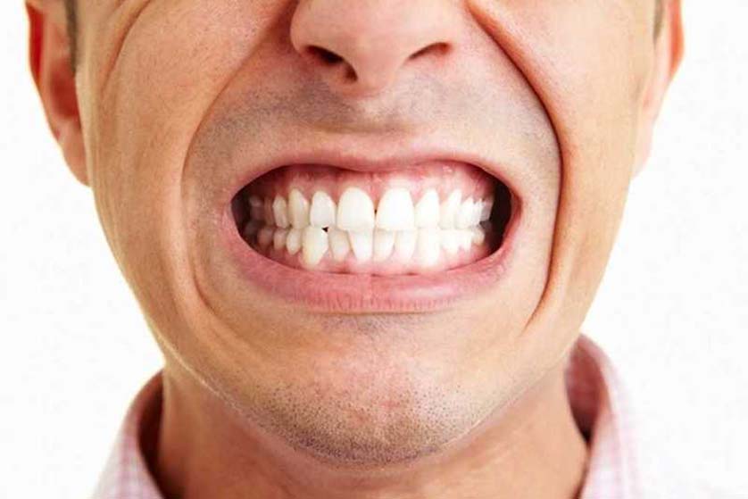 Bruxism Treatment: How to Stop Grinding Your Teeth at Night