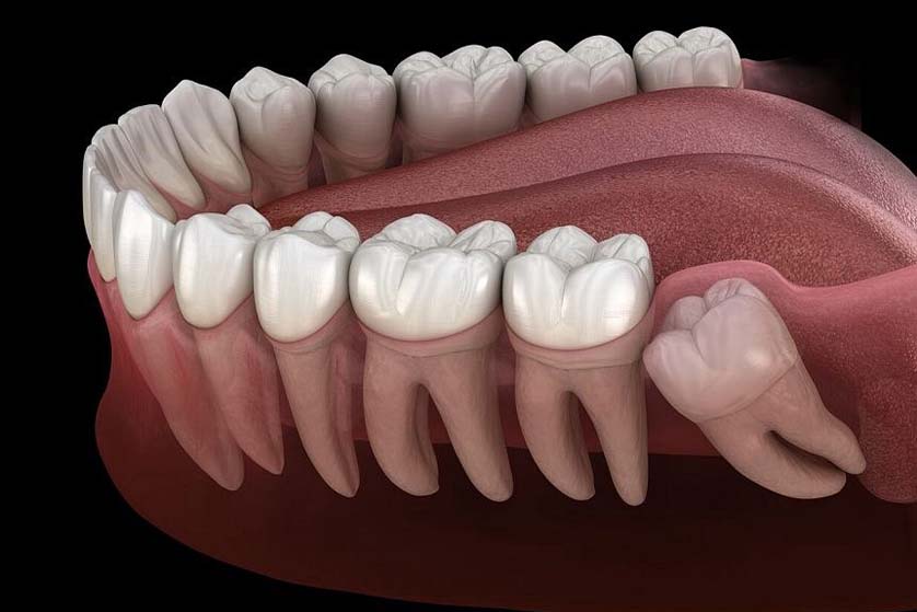 Impacted Wisdom Molars
