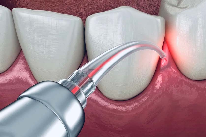 Best Laser Dentistry in Delhi