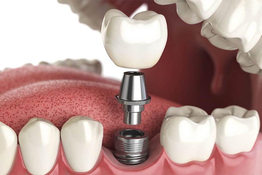 Nobel Biocare Dental Implants in Delhi, India