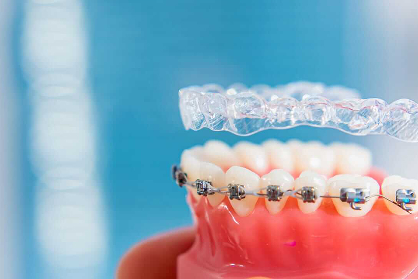 Best Braces and Aligners Treatment in Delhi