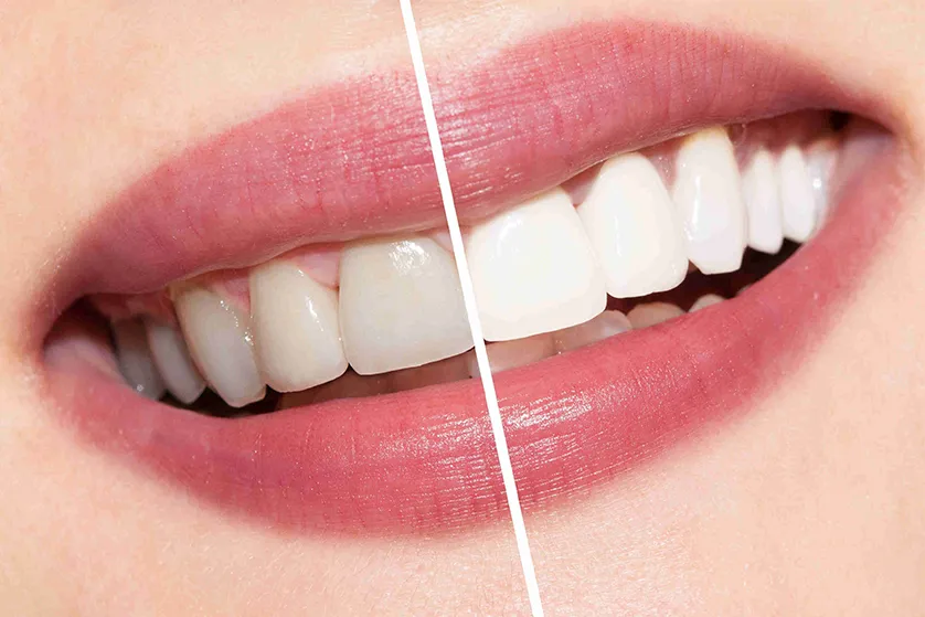 White Spots on Teeth: Causes, Whitening and Treatment