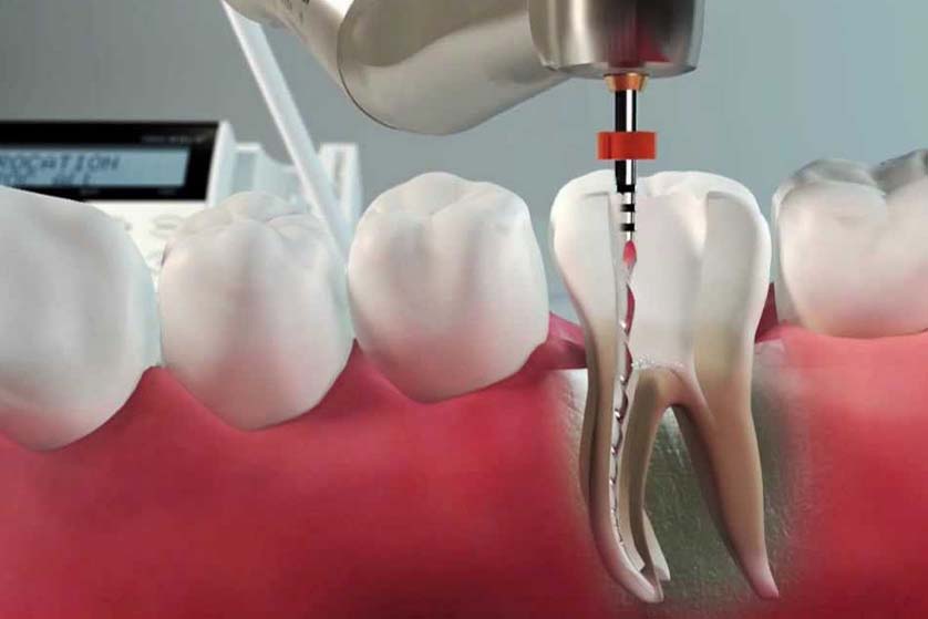 Best Root Canal Treatment in India