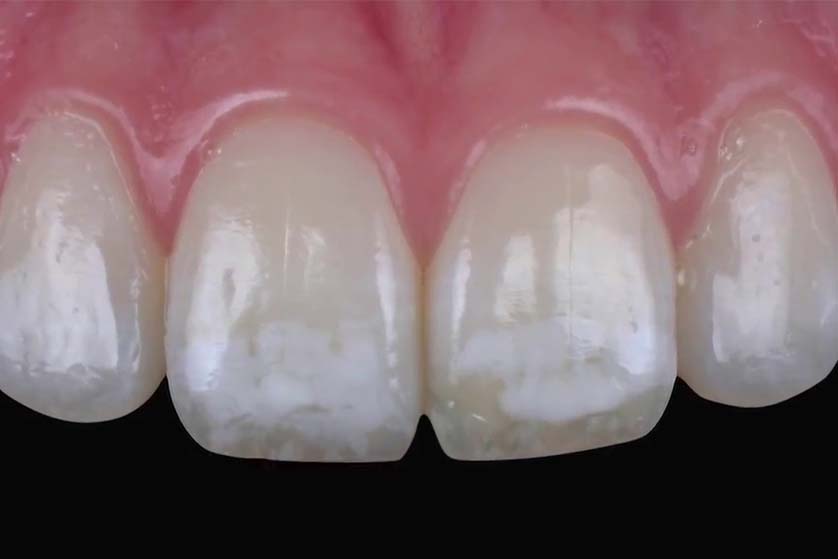 White Spots on Teeth - Causes, Treatment, and Prevention