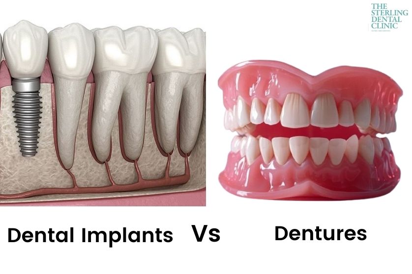 Dental Implants vs. Dentures: Which Is Right for You?