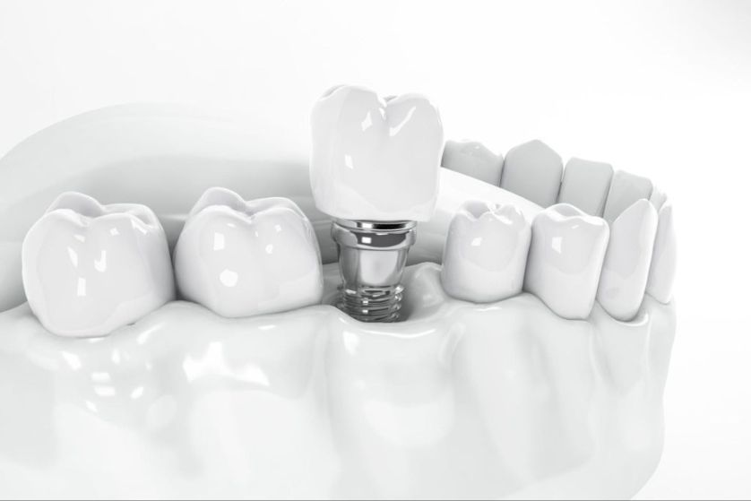 Dental Implants