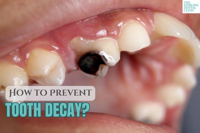 How to Prevent Tooth Decay: Expert Tips from Dentists