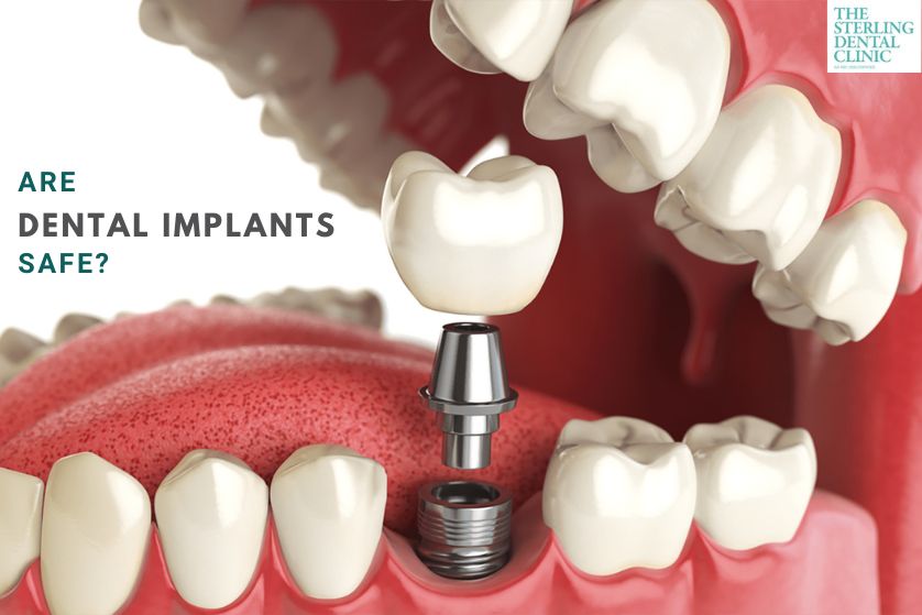 Are Dental Implants Safe? Understanding the Risks and Benefits