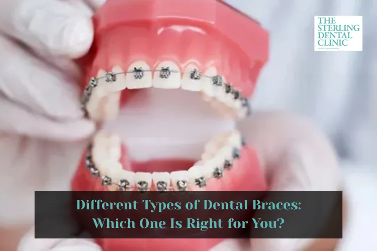 Different Types of Dental Braces: Which One Is Right for You?
