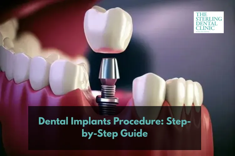 Dental Implant Procedure: A Step-by-Step Guide