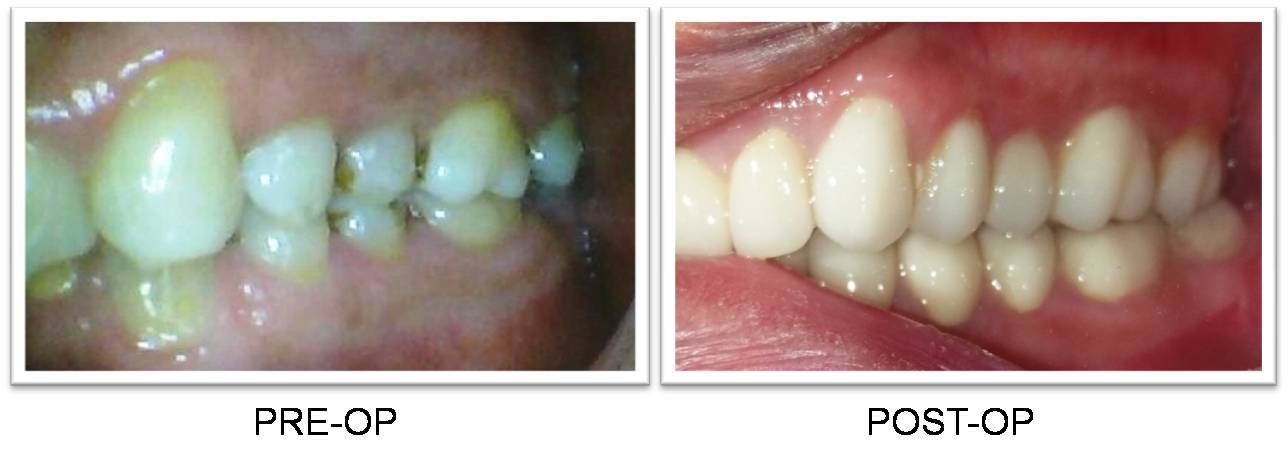 Dental Veneers in Delhi Before and After
