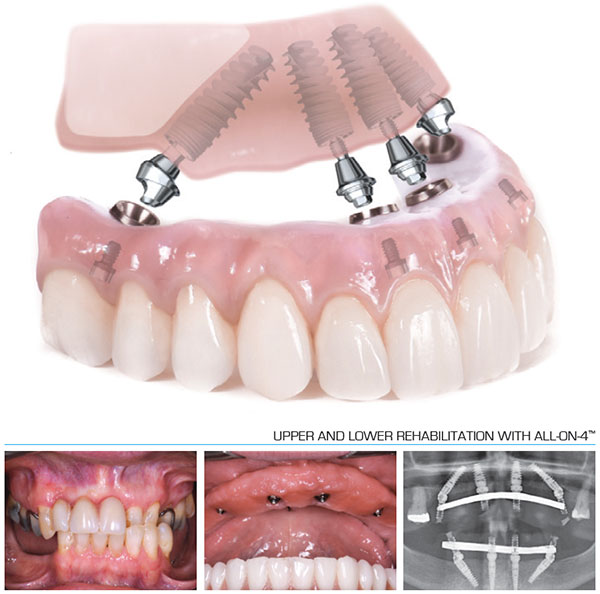 Upper and Lower teeth rehabilitation