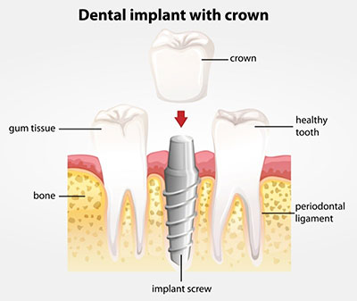 Dental Implants with crown