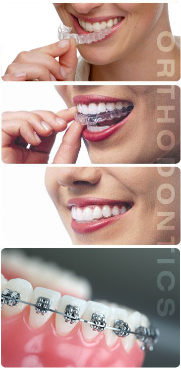Orthodontic Dentistry - Dental Braces in Delhi