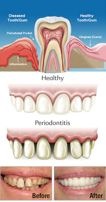 Gum Infection Treatment, Periodontal treatment effects