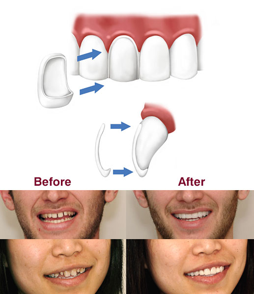 Dental Veneers in Delhi Before and After