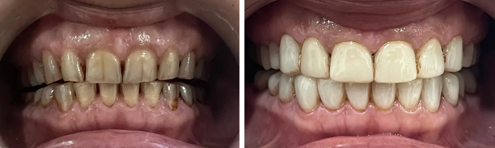 Before and after: worn, stained teeth rebuilt with ceramic crowns, upper and lower