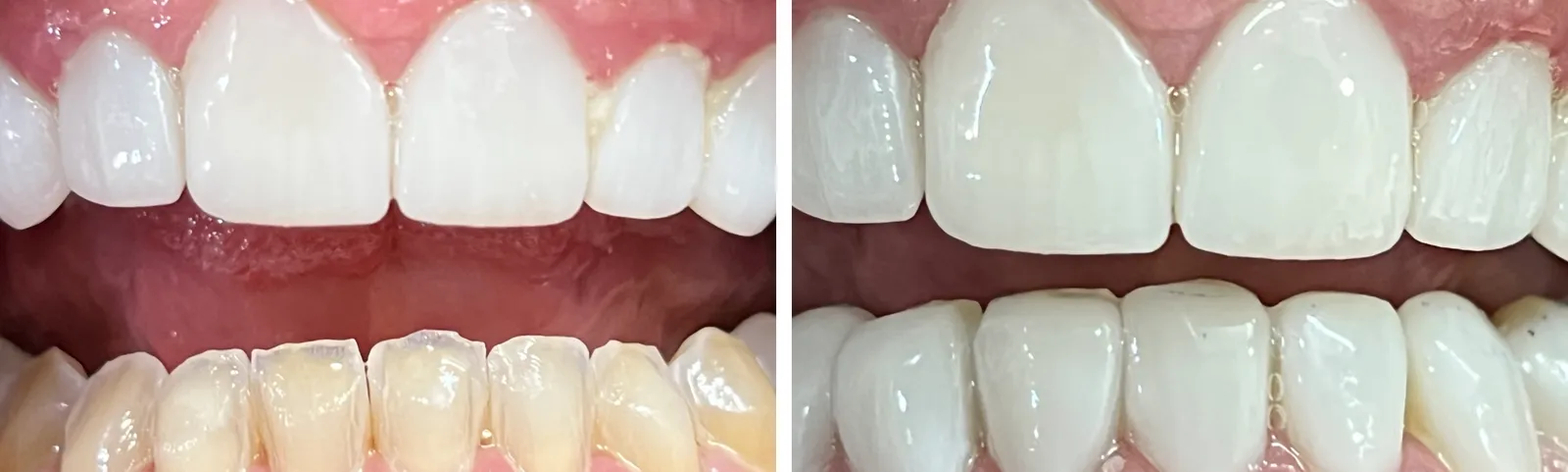 Before and after: upper and lower arches restored with ceramic crowns