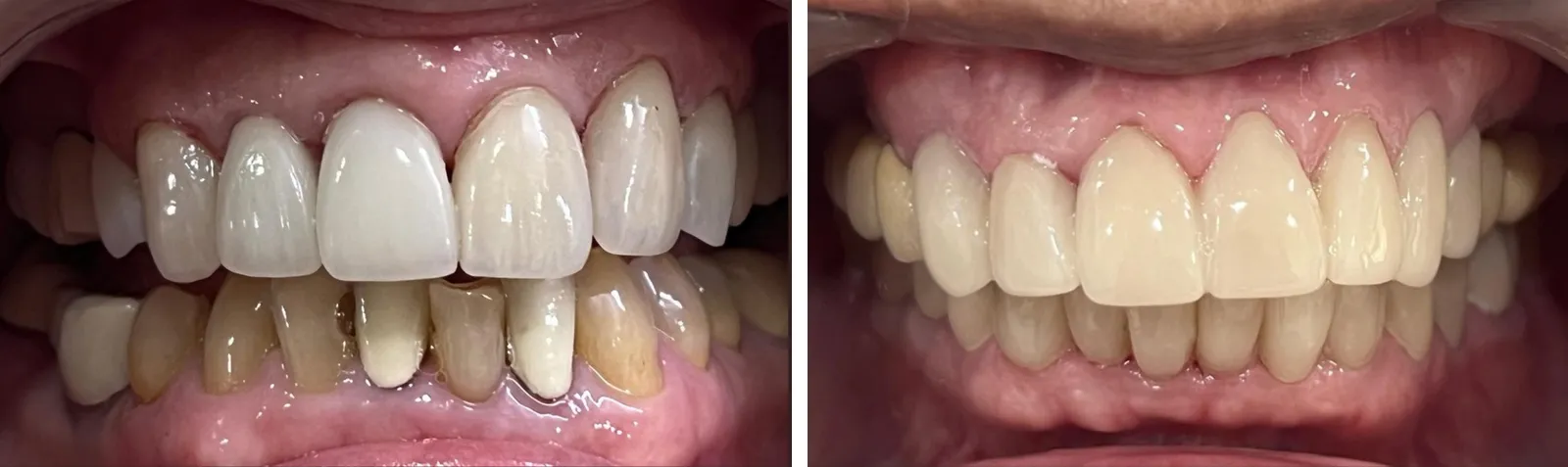 Before and after: discoloured, uneven teeth rebuilt with full-mouth ceramic crowns