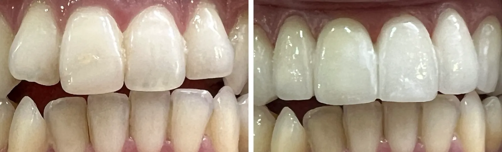 Before and after: crowded, chipped front teeth reshaped with ceramic restorations