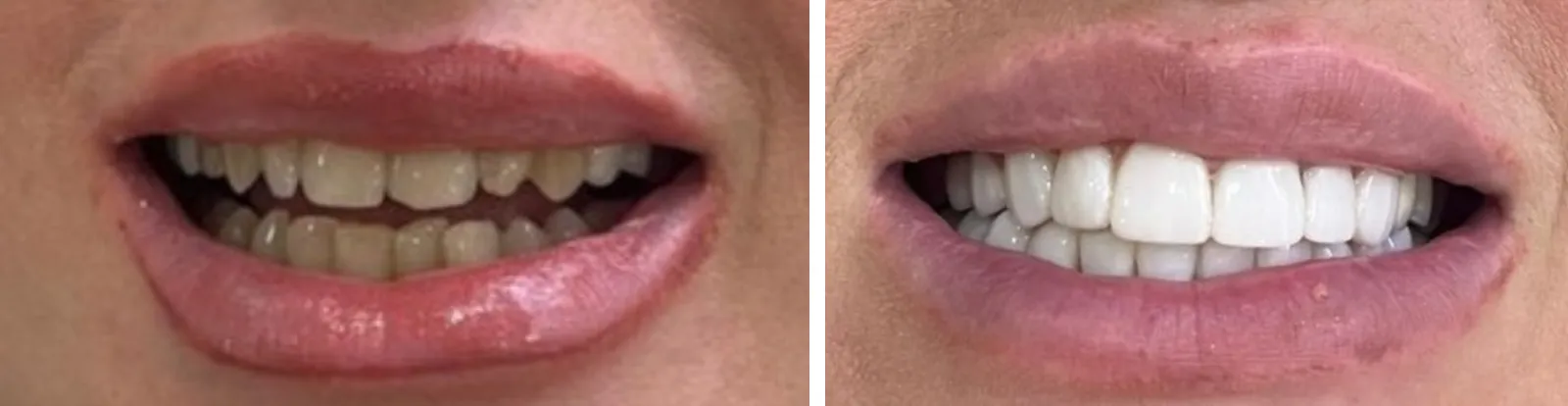 Before and after: discoloured, uneven front teeth to a bright, even smile