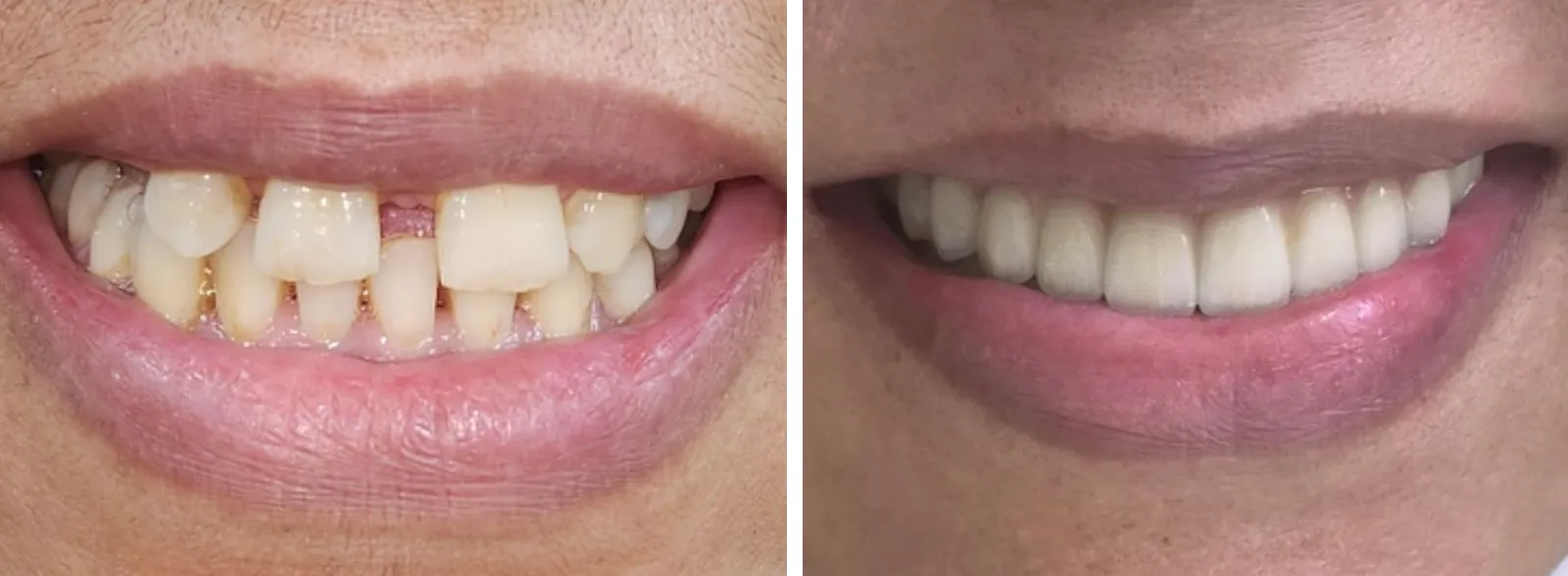 Before and after: gaps and chipped edges closed with ceramic restorations