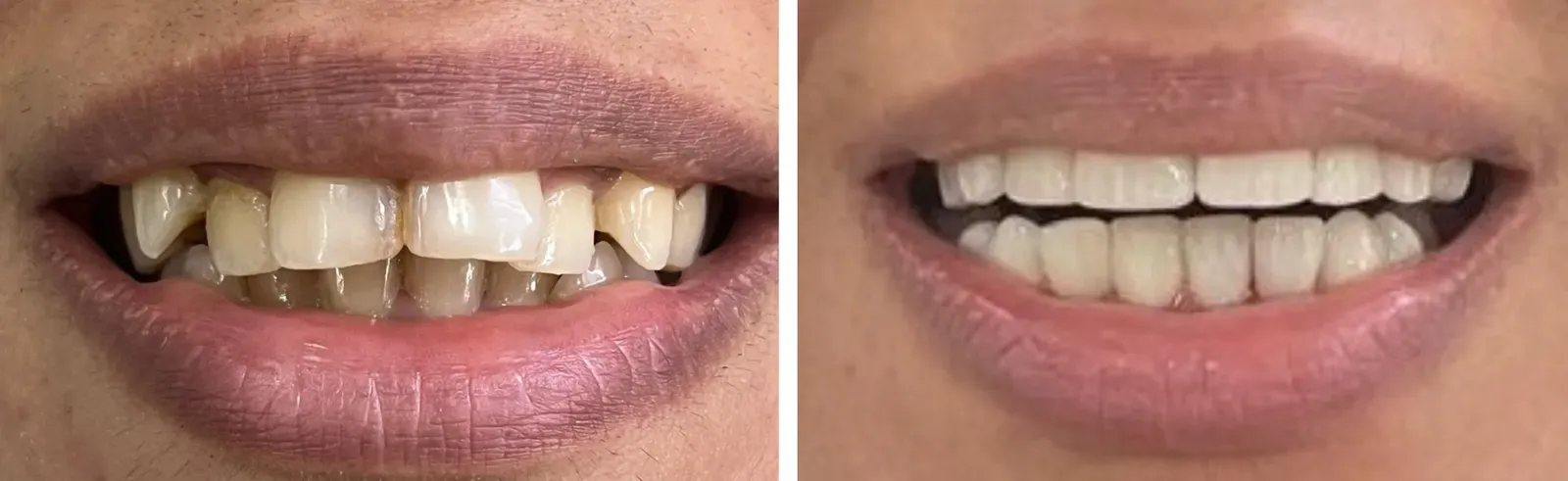 Before and after: broken, worn and stained teeth rebuilt with ceramic crowns, upper and lower