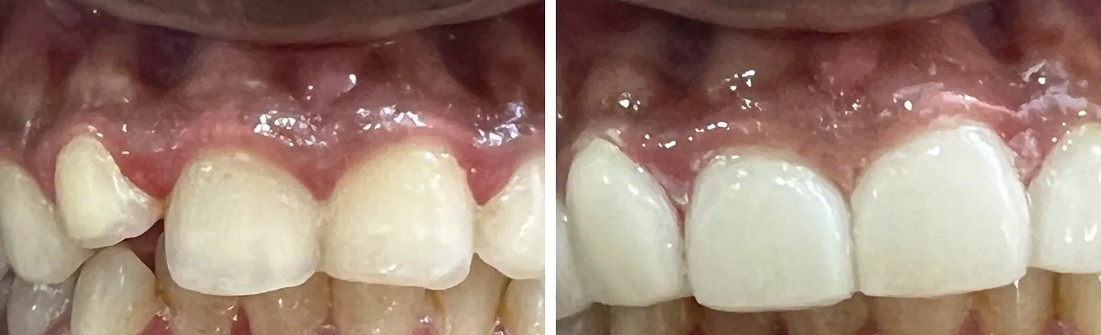 Before and after: crowded, overlapping front teeth made even with ceramic restorations