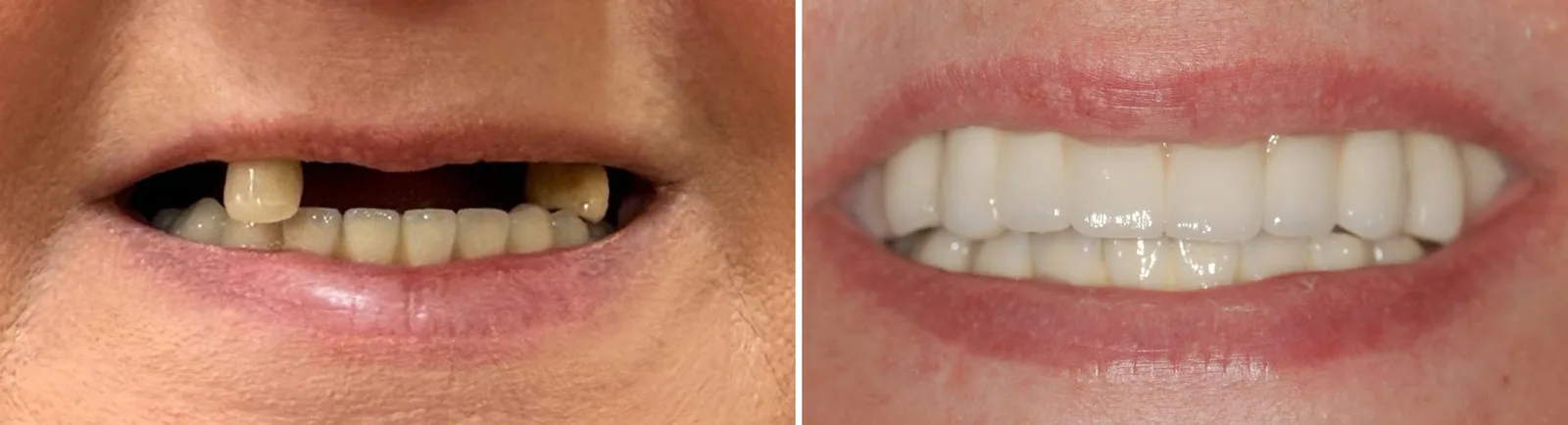 Before and after: missing and failing teeth replaced with fixed implant-supported teeth, upper and lower
