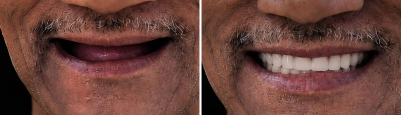 Before and after: a toothless upper jaw given a fixed set of teeth on implants