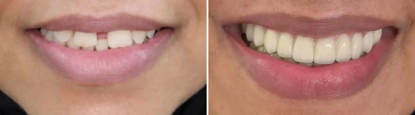 Before and after: gapped, uneven upper teeth replaced with a fixed all-on-4 bridge