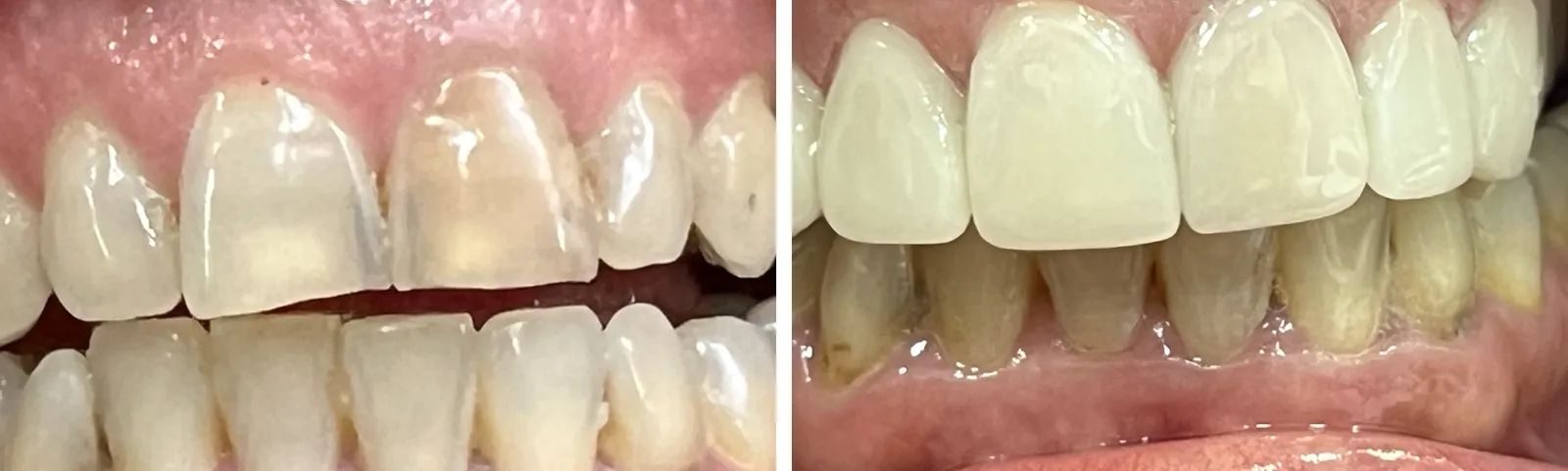 Before and after: dark, discoloured front teeth covered with ceramic veneers