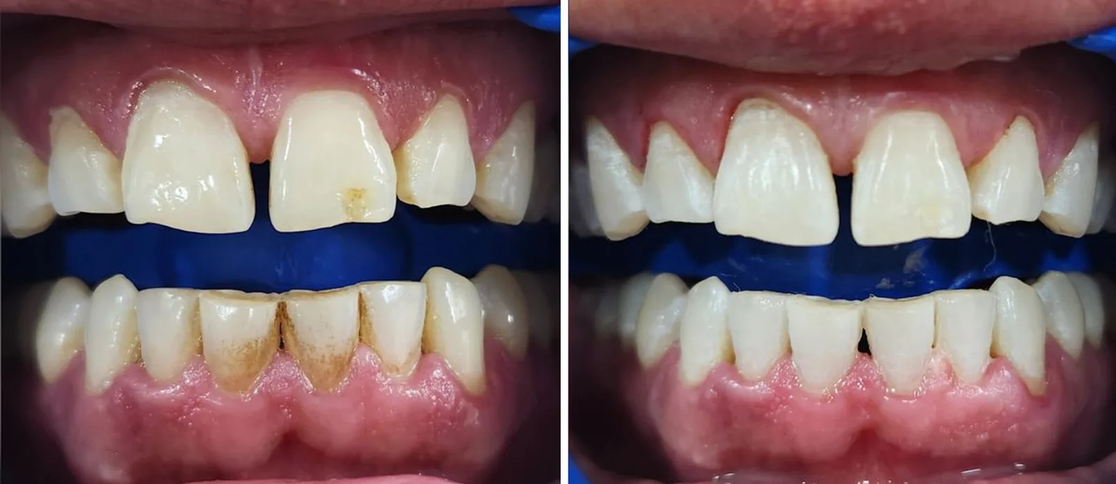 Before and after: heavy stain and tartar removed with a professional scaling and polish