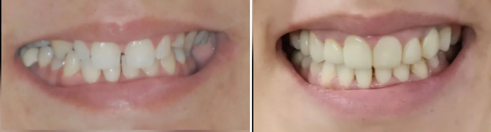 Before and after: grey, uneven teeth made even and natural-looking with ceramic restorations