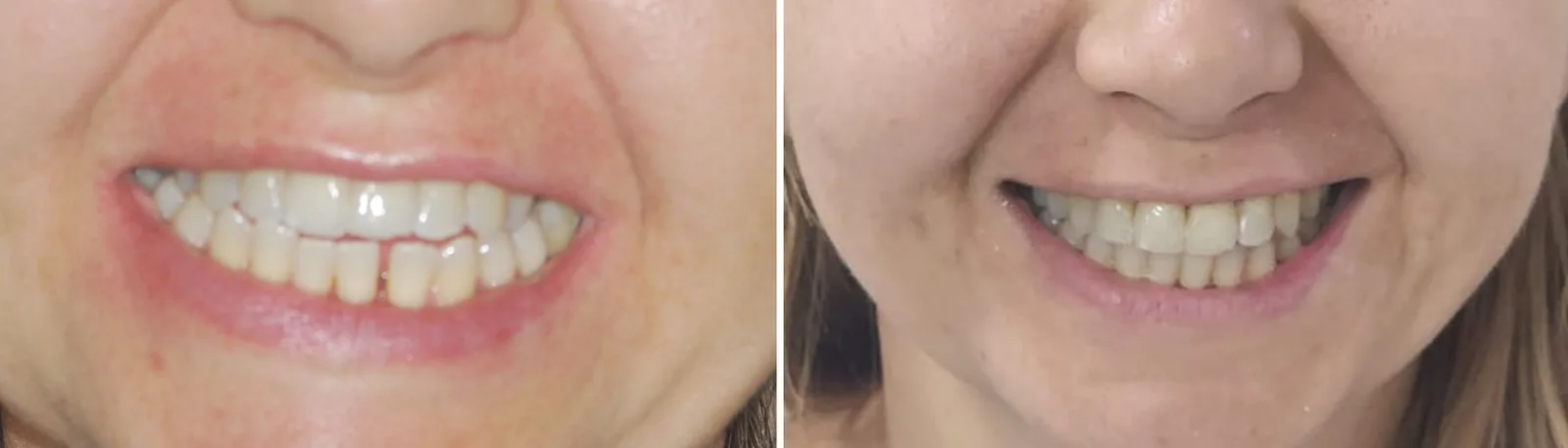 Before and after: crowded, uneven teeth straightened with orthodontic treatment