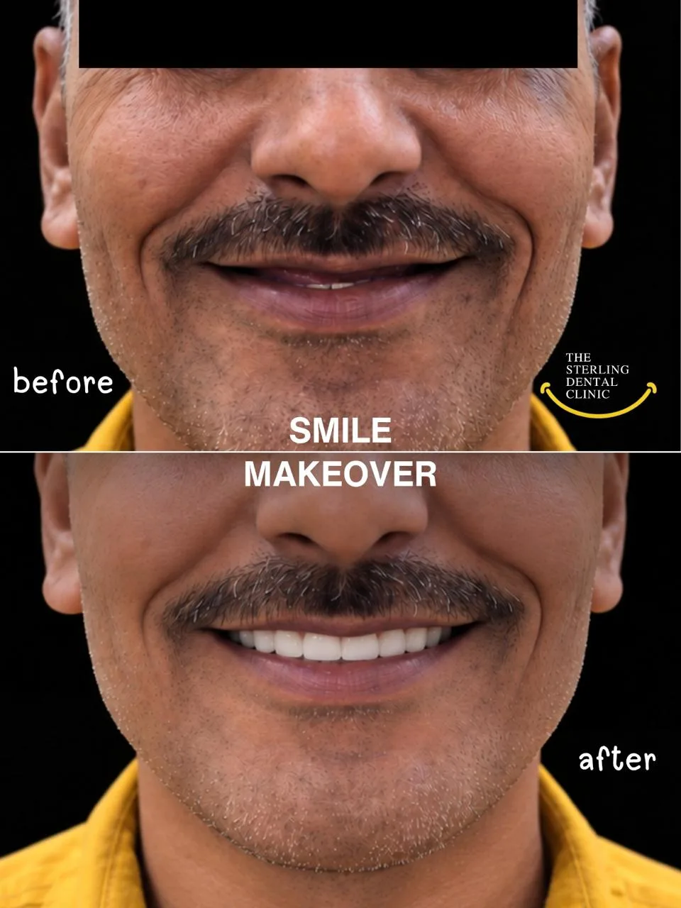 Before (above) and after (below): small, worn front teeth rebuilt into a full, even smile