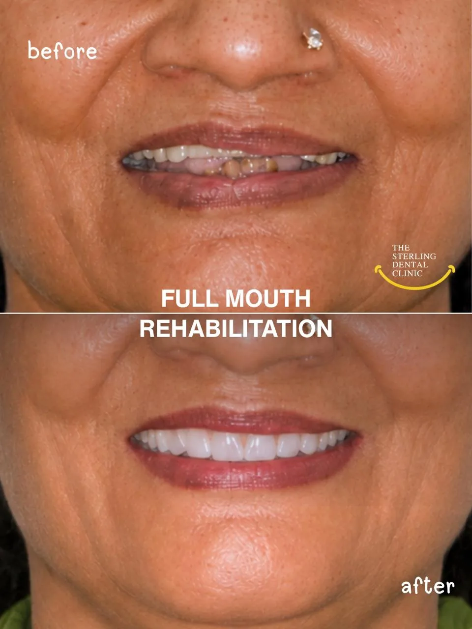 Before (above) and after (below): broken, missing and worn teeth rebuilt, upper and lower