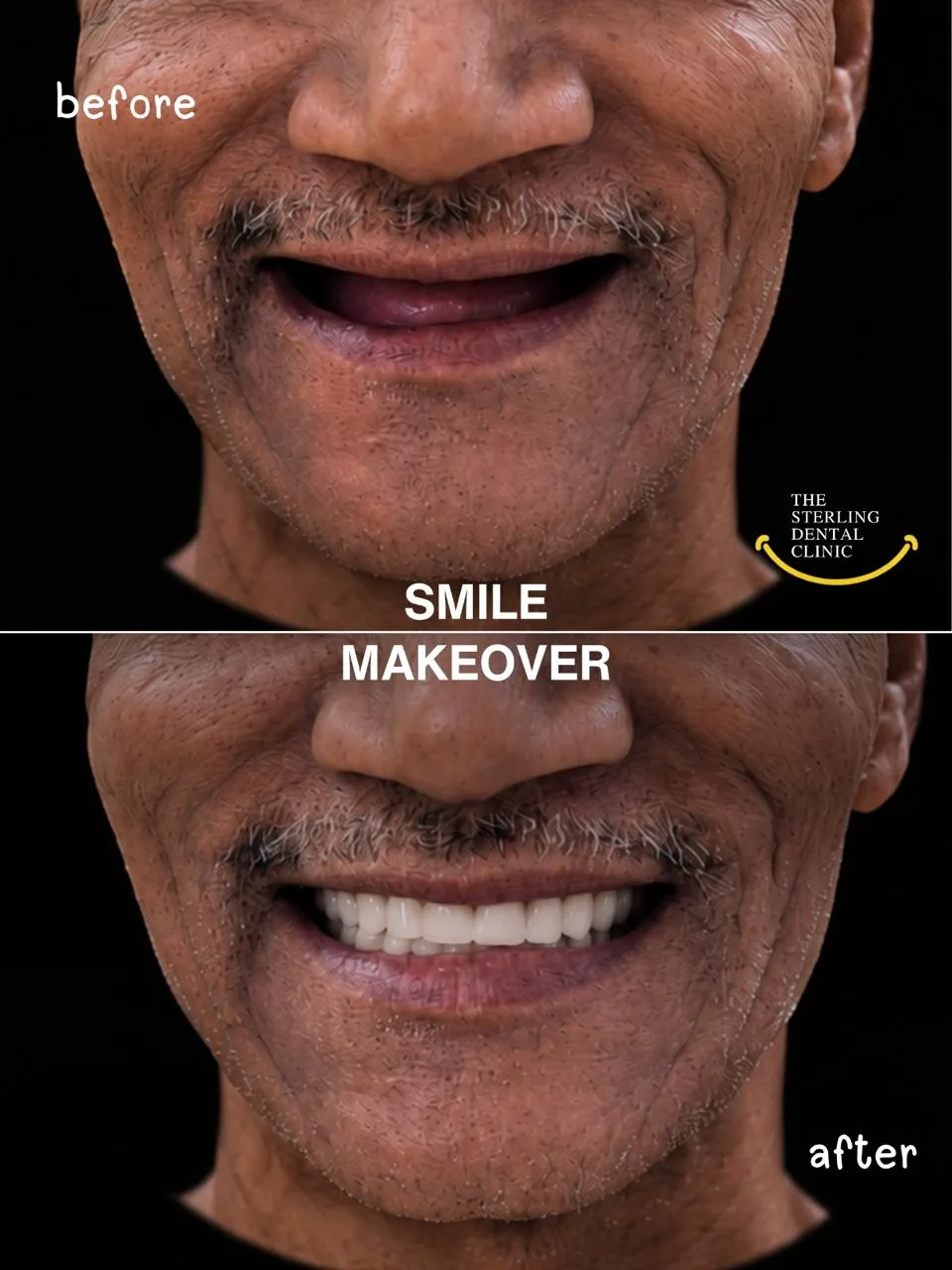 Before (above) and after (below): missing upper teeth replaced with a full, natural-looking smile